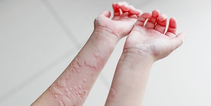 What Are Hives Symptoms Causes Diagnosis Treatment And Prevention Everyday Health