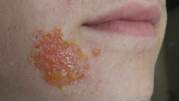 impetigo