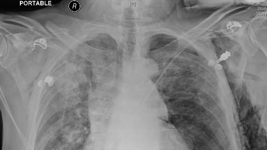 CXR lotspng