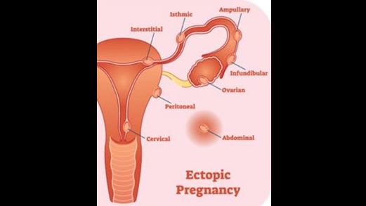 Ectopic long