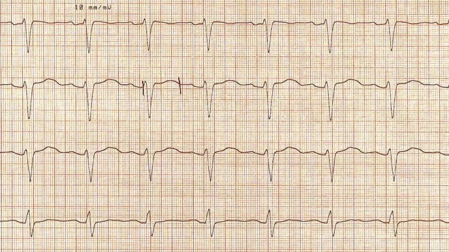 ECG
