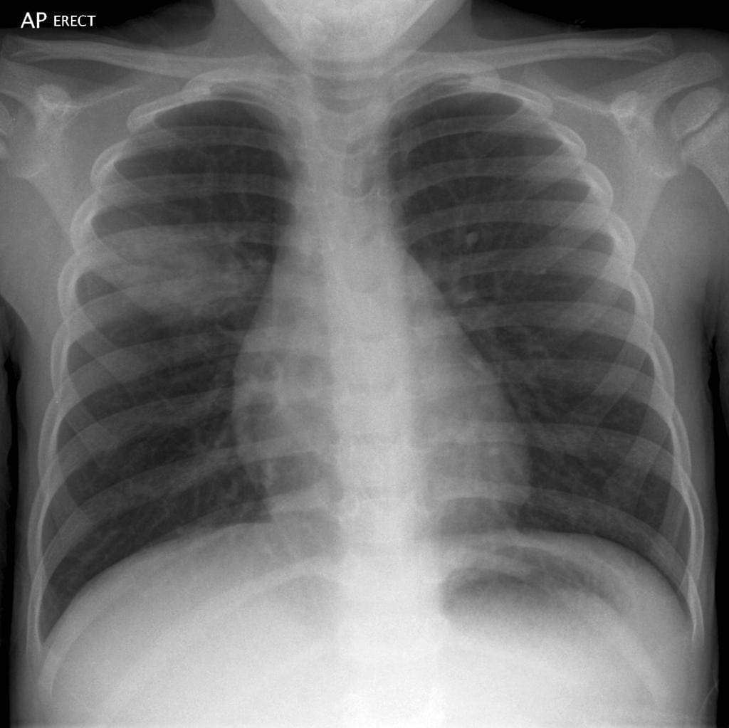 round-pneumonia-8