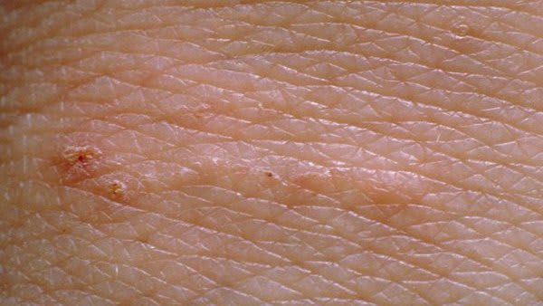 M2600040-Scabies_rash_on_skin-SPL.original