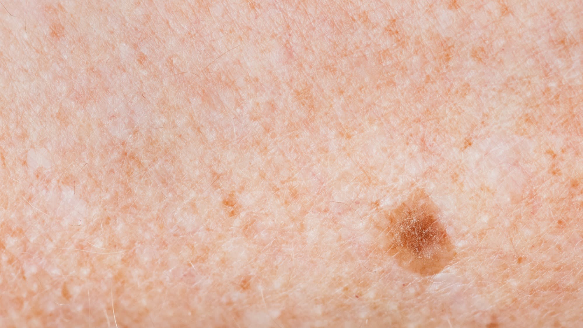closeup-of-freckled-skin-2025-02-10-08-36-57-utc