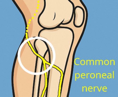 Common peron nervee