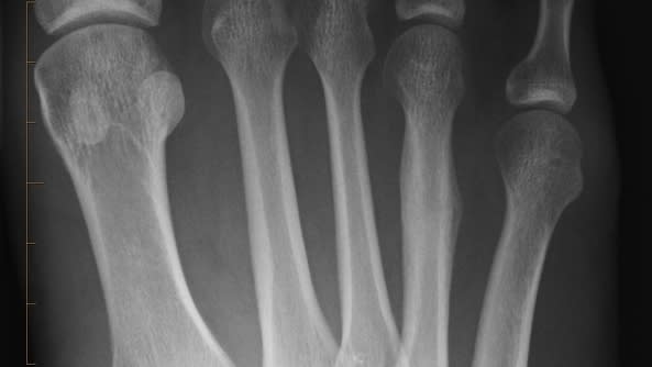 healing march fracture