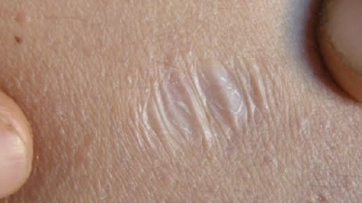 Atrophic_scar_of_Ehlers_Danlos_syndrome
