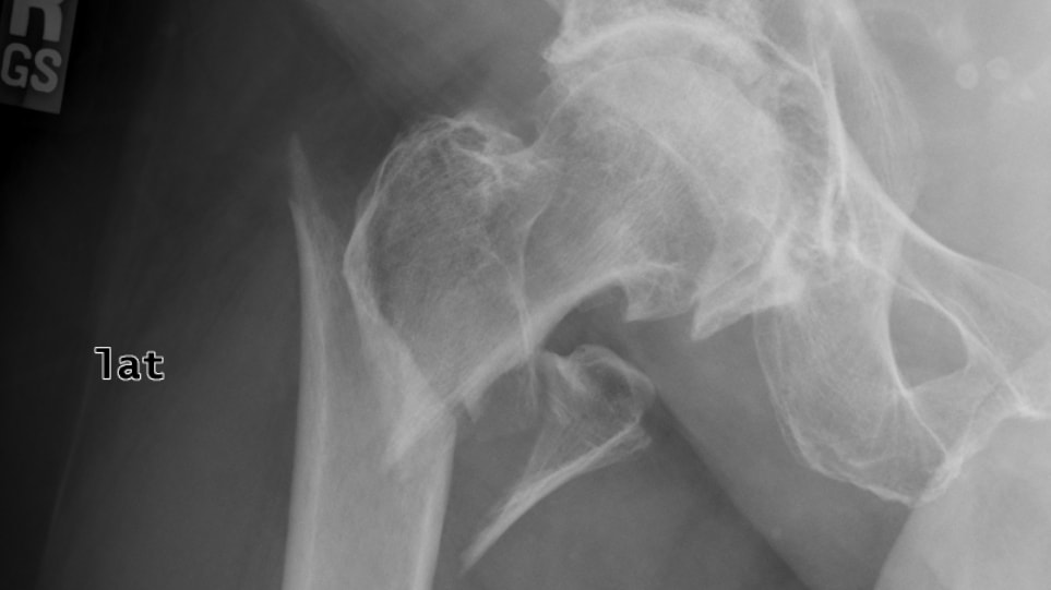 subtrochanteric-fracture
