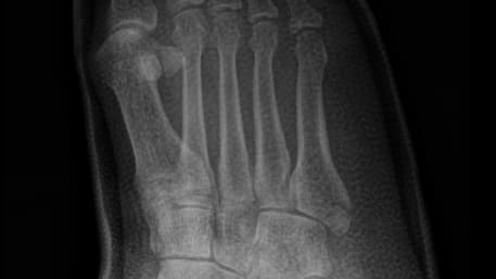 2b361a13Avulsion fracture