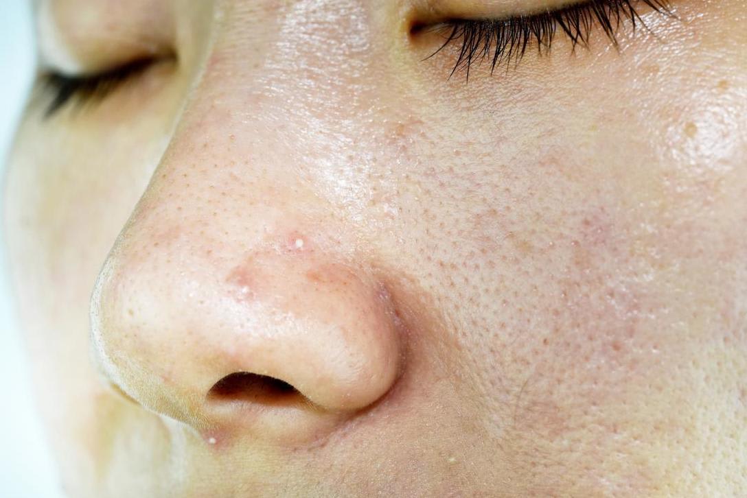 oily skin