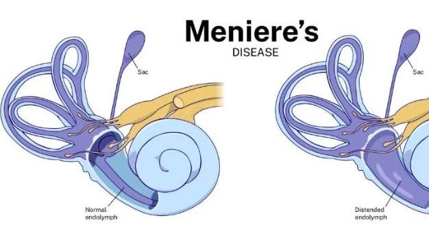 menre