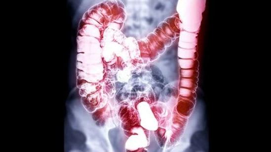 long bowel