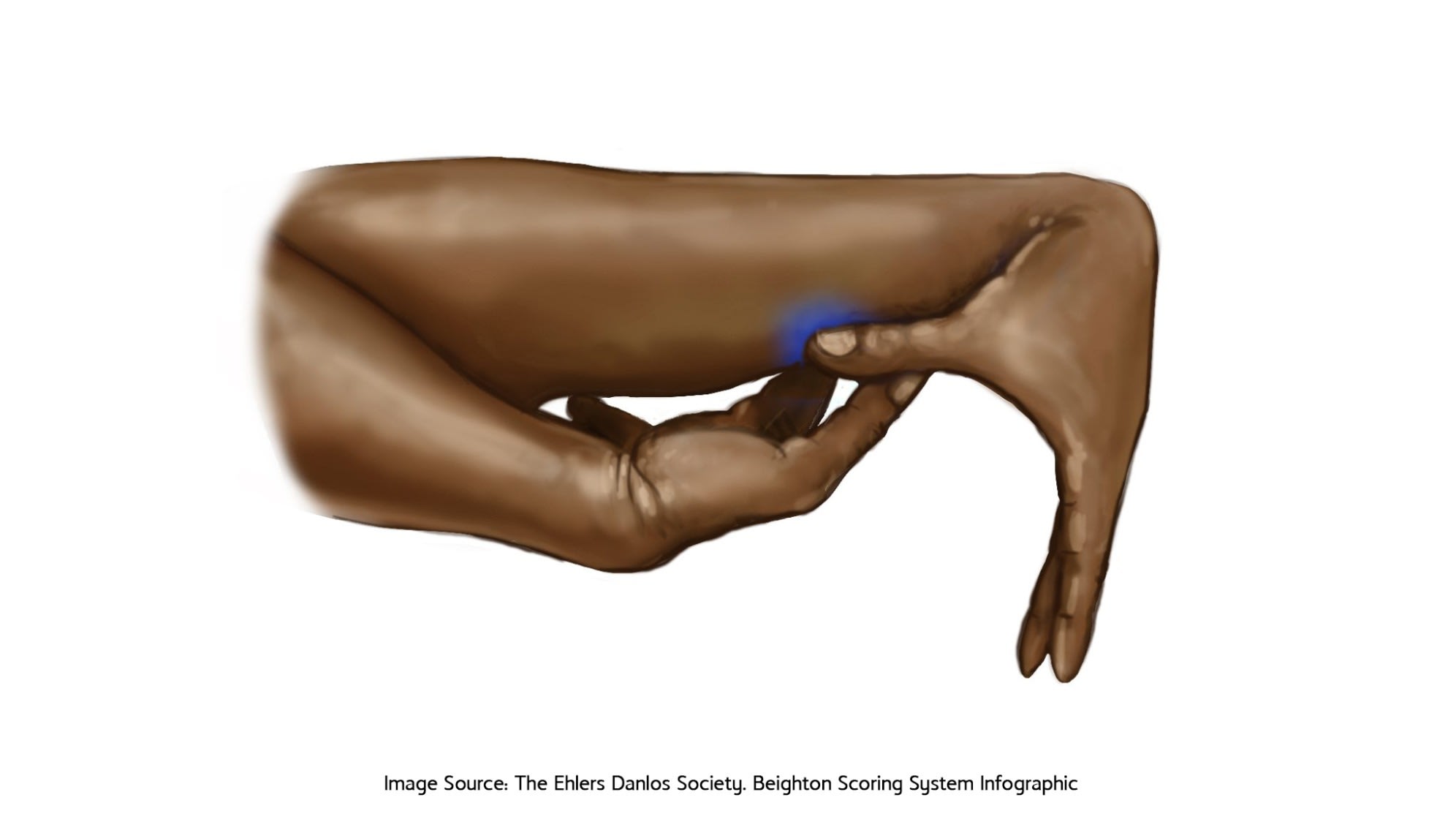 EDS - Thumb