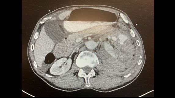 long rup kidney