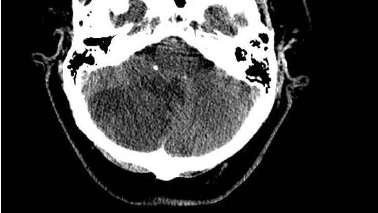 Cerebellar infarc radiop