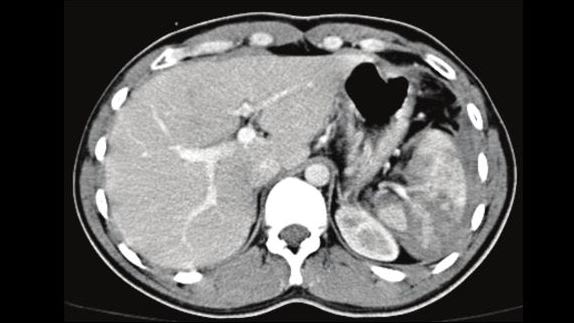 long rup spleen
