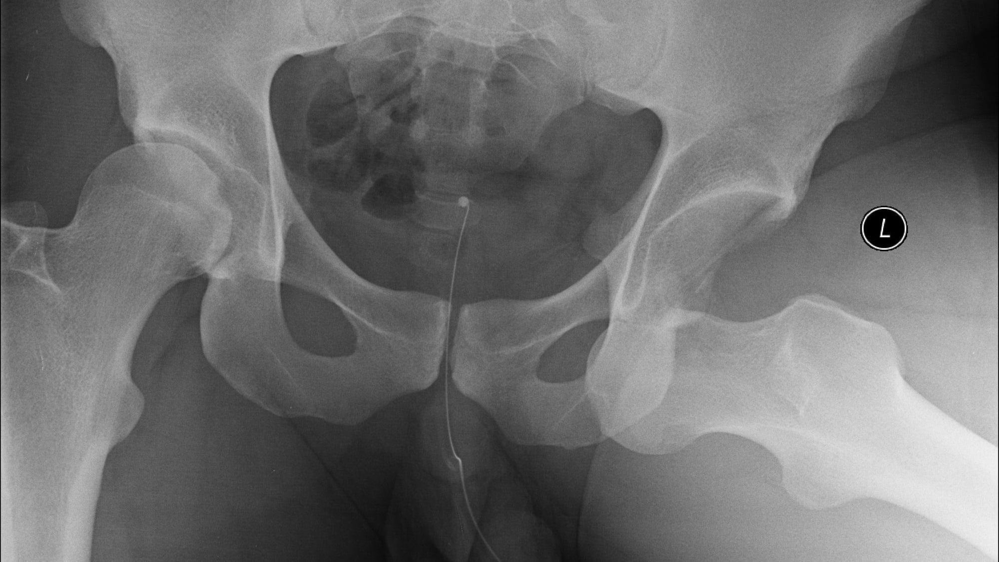 anterior-dislocation-of-the-hip