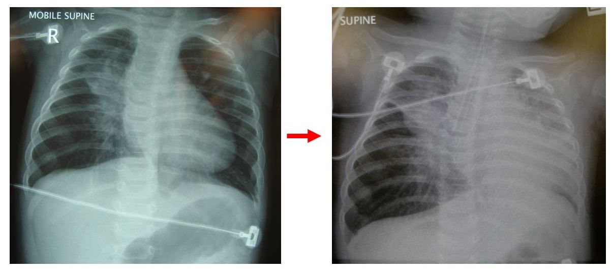 CXR times 2
