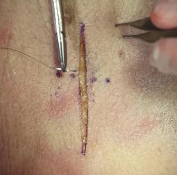 Vert Mattress suture