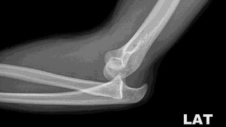ray-case-shows-a-posterior-dislocation-of-the-elbow-41