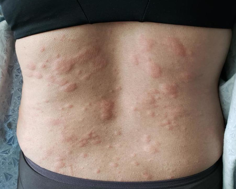 hives