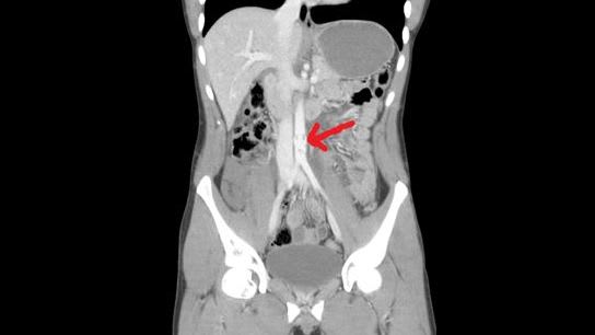 long blunt aortic