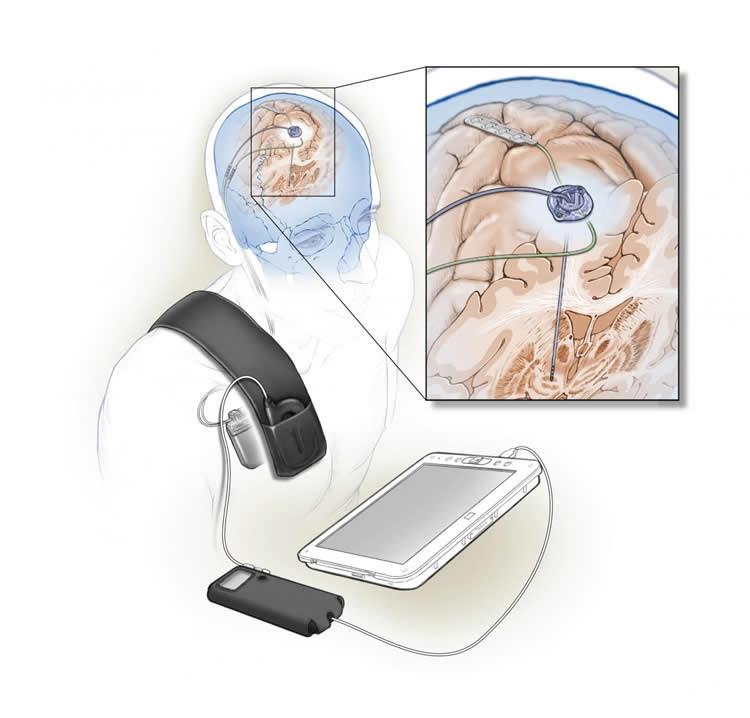 parkinsons-self-tuning-implant-neurosciencenews