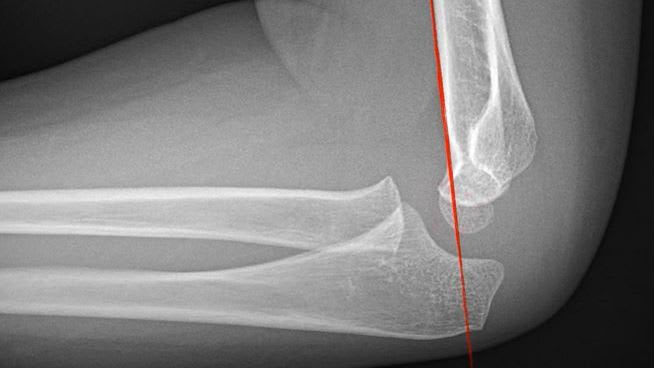Ant humeral line not middle third cap radio snip