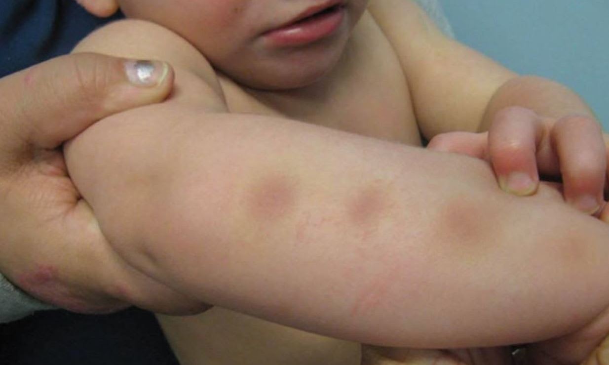 bruise arm