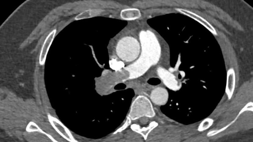 Right PE 30yr old