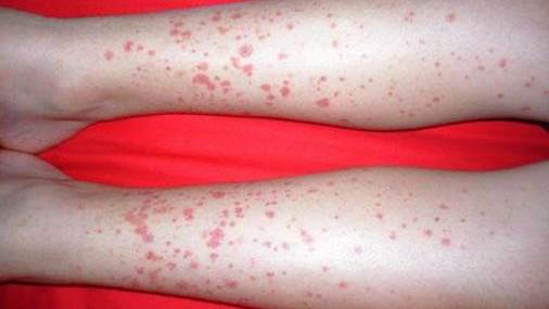 16 HSP  Legs