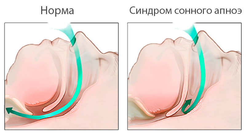 apnoe