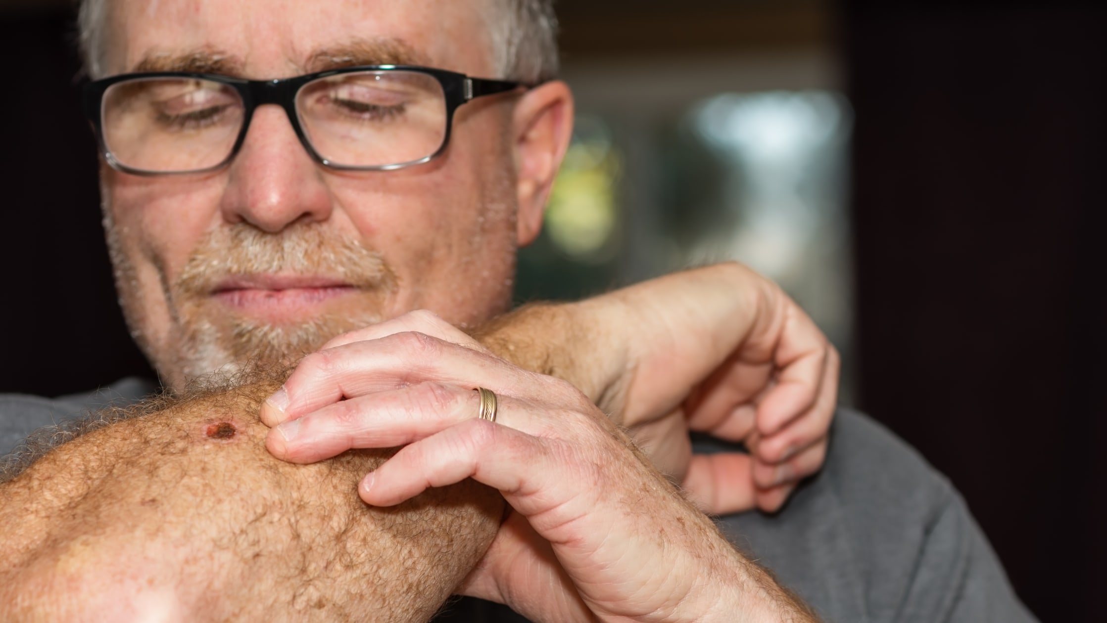 skin+cancer+look+like