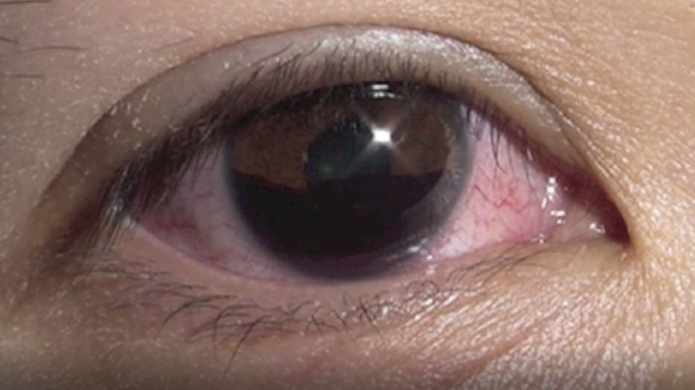 Hyphaema