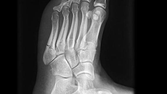 Jones fracture radiopaedia