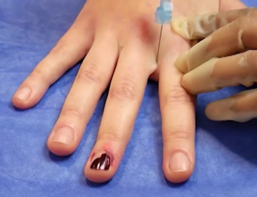Digital nerve blockJPG