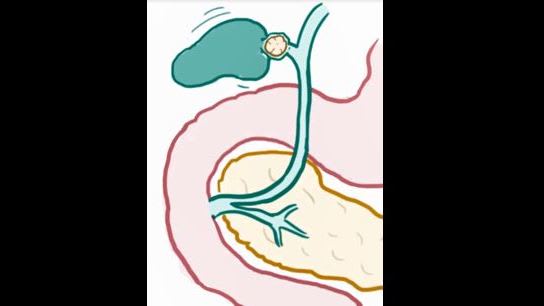 cyst d long