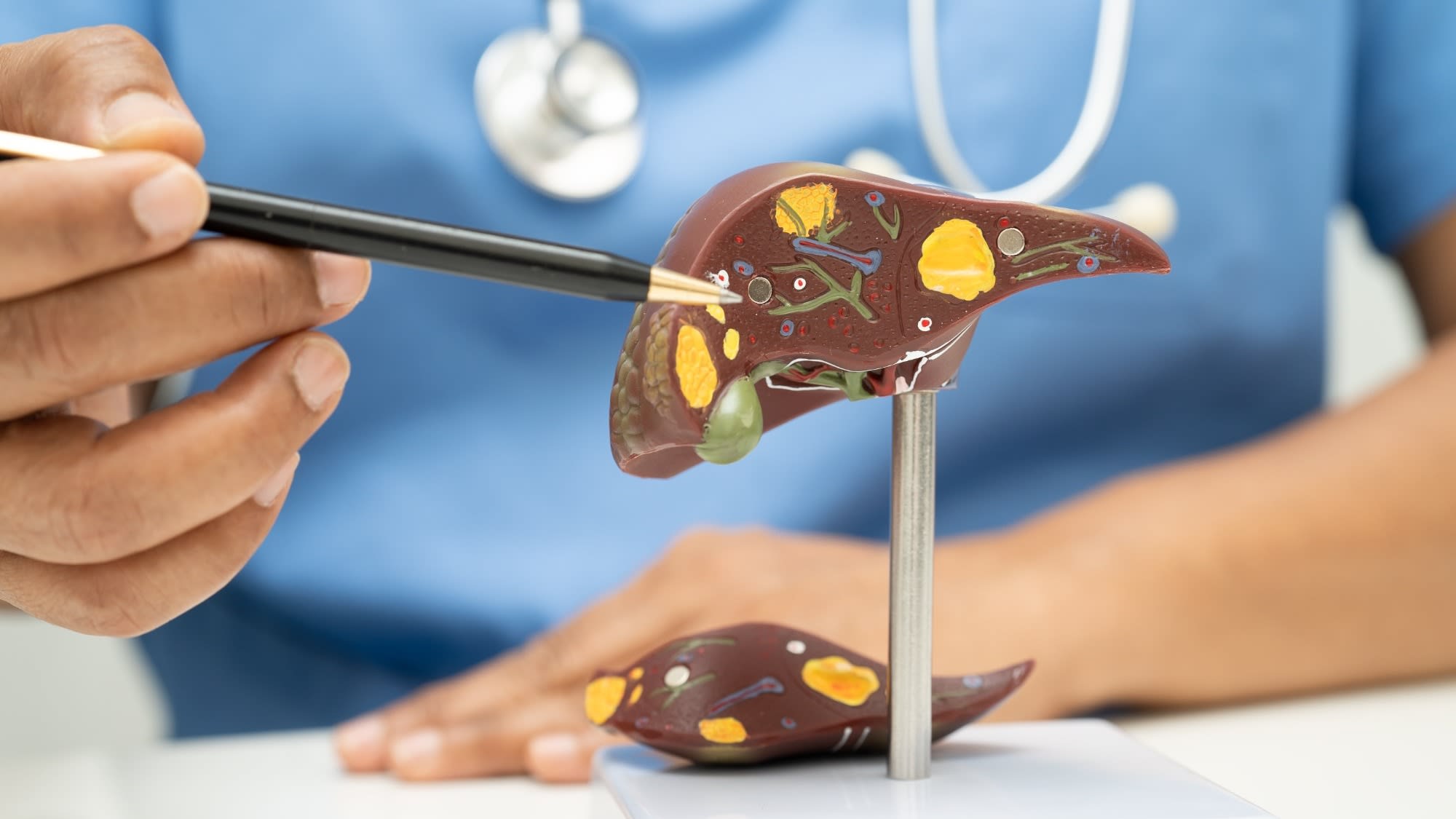 cirrhosis-liver-cancer-fatty-liver-asian-doctor-2025-02-24-16-46-47-utc