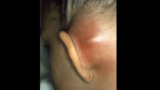 mastoiditis long