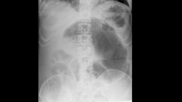 Cecal volvulus long
